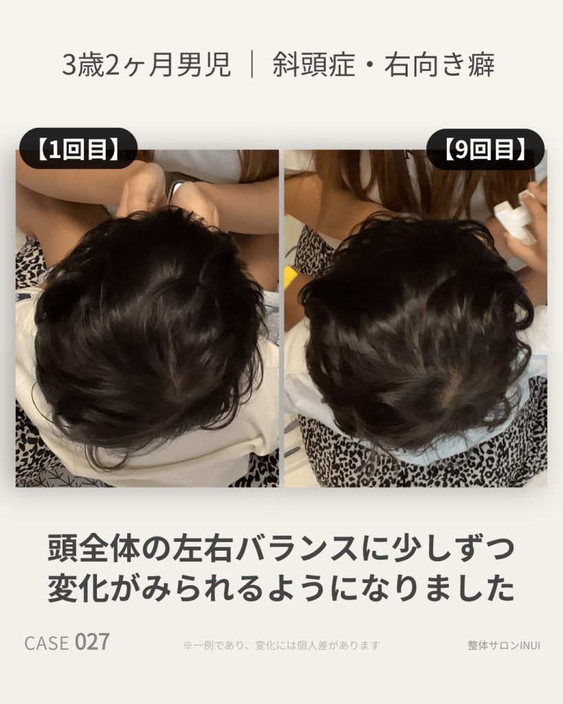 3歳2ヶ月男児の斜頭症ビフォーアフター比較