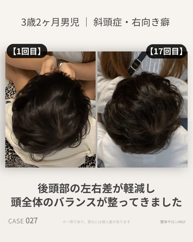 3歳2ヶ月男児の斜頭症ビフォーアフター比較