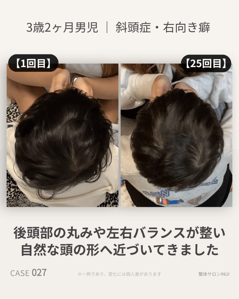 3歳2ヶ月男児の斜頭症ビフォーアフター比較