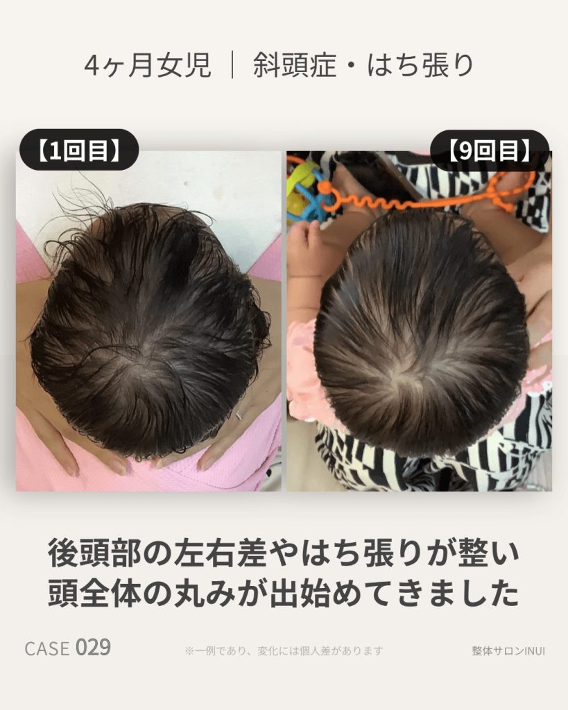 生後4ヶ月女児の斜頭症ビフォーアフター比較