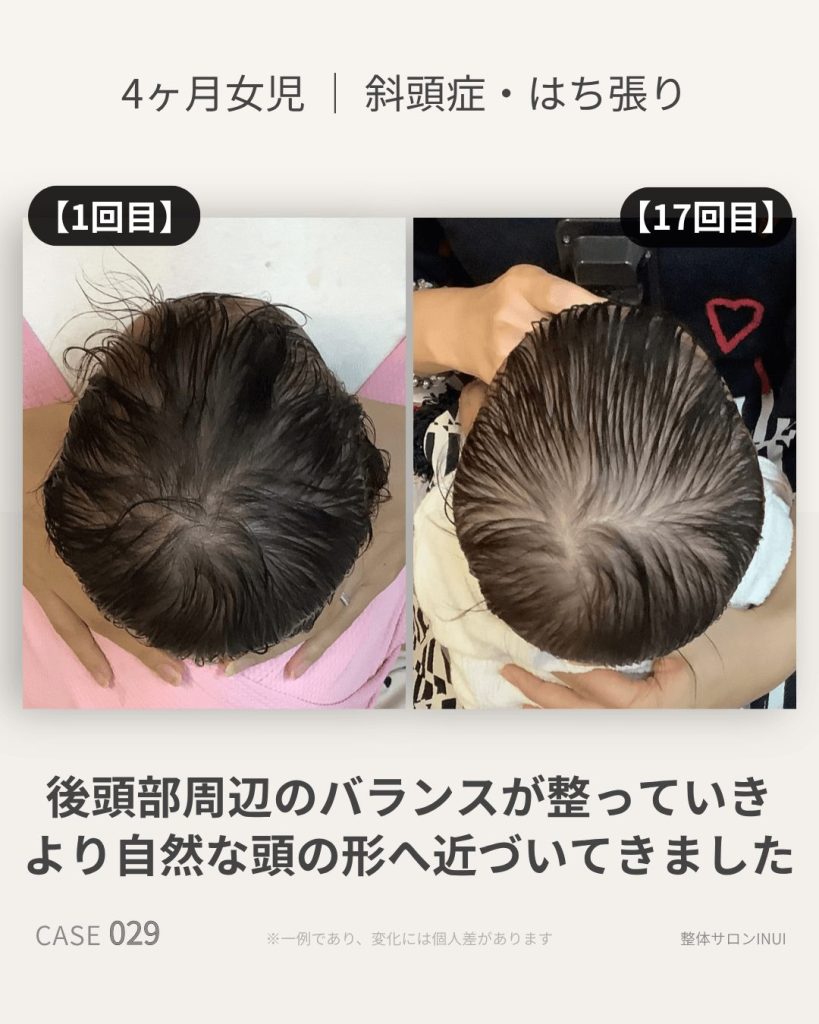 生後4ヶ月女児の斜頭症ビフォーアフター比較