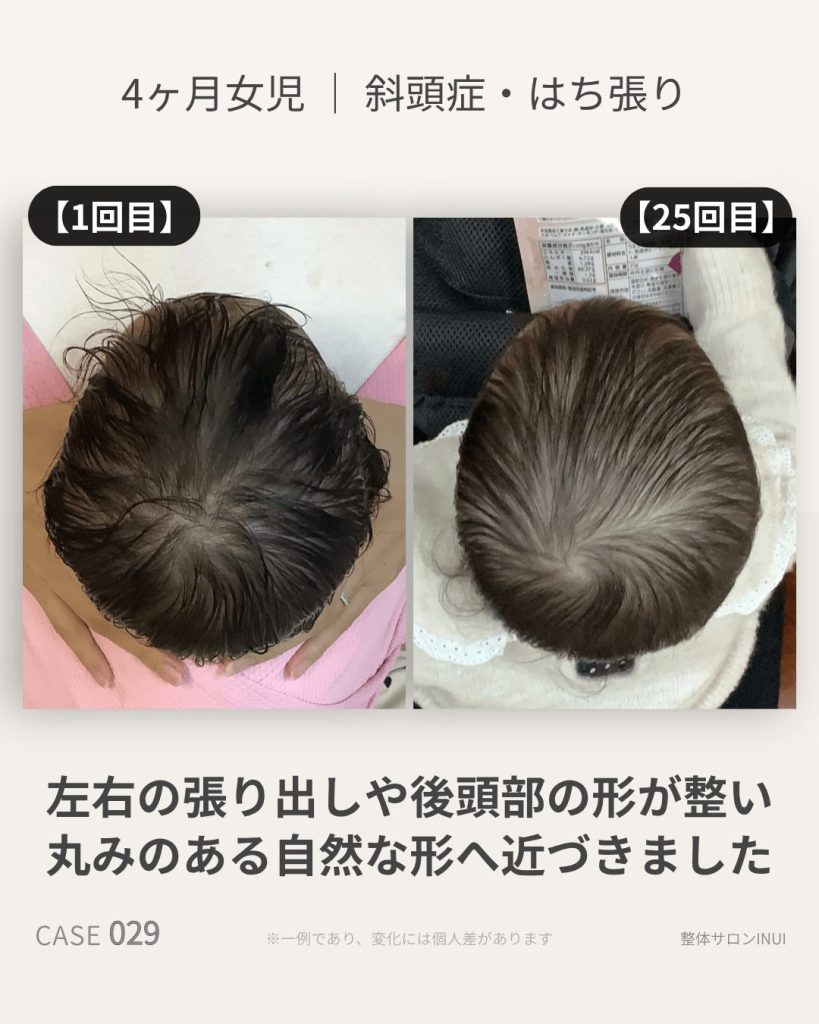 生後4ヶ月女児の斜頭症ビフォーアフター比較