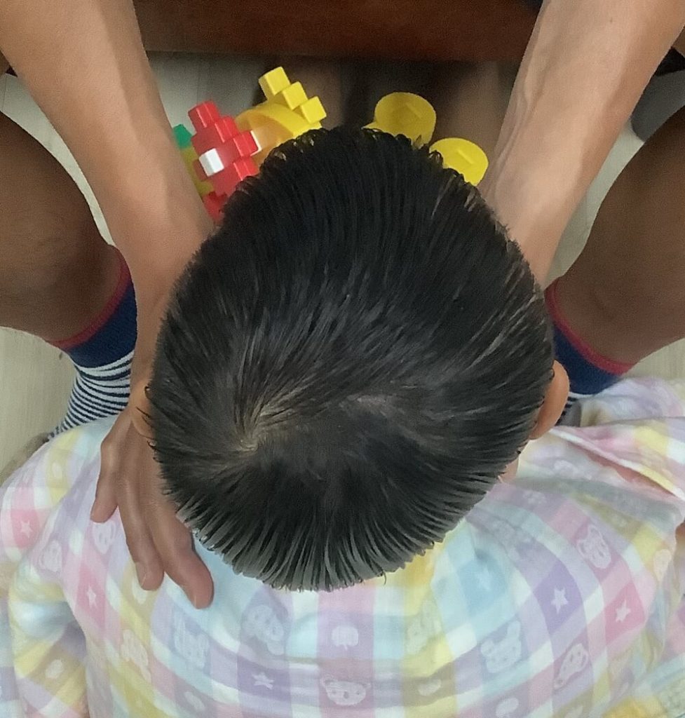 5歳2ヶ月男児の斜頭症による後頭部左右差