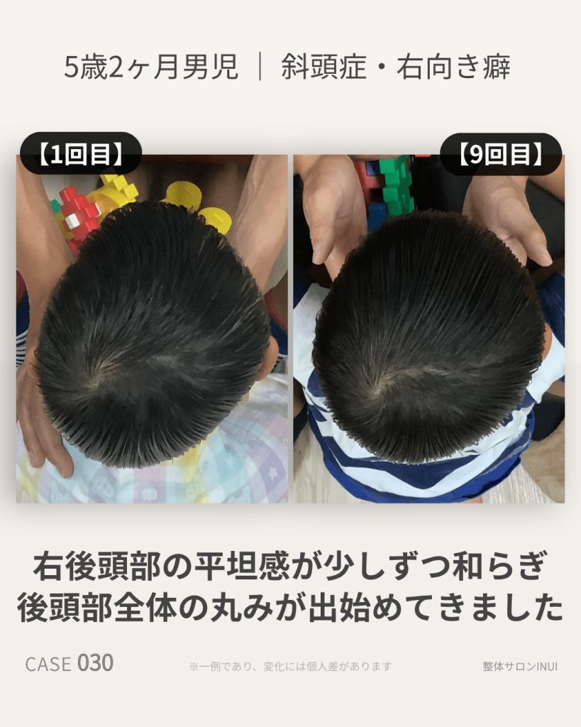 5歳2ヶ月男児の斜頭症ビフォーアフター比較