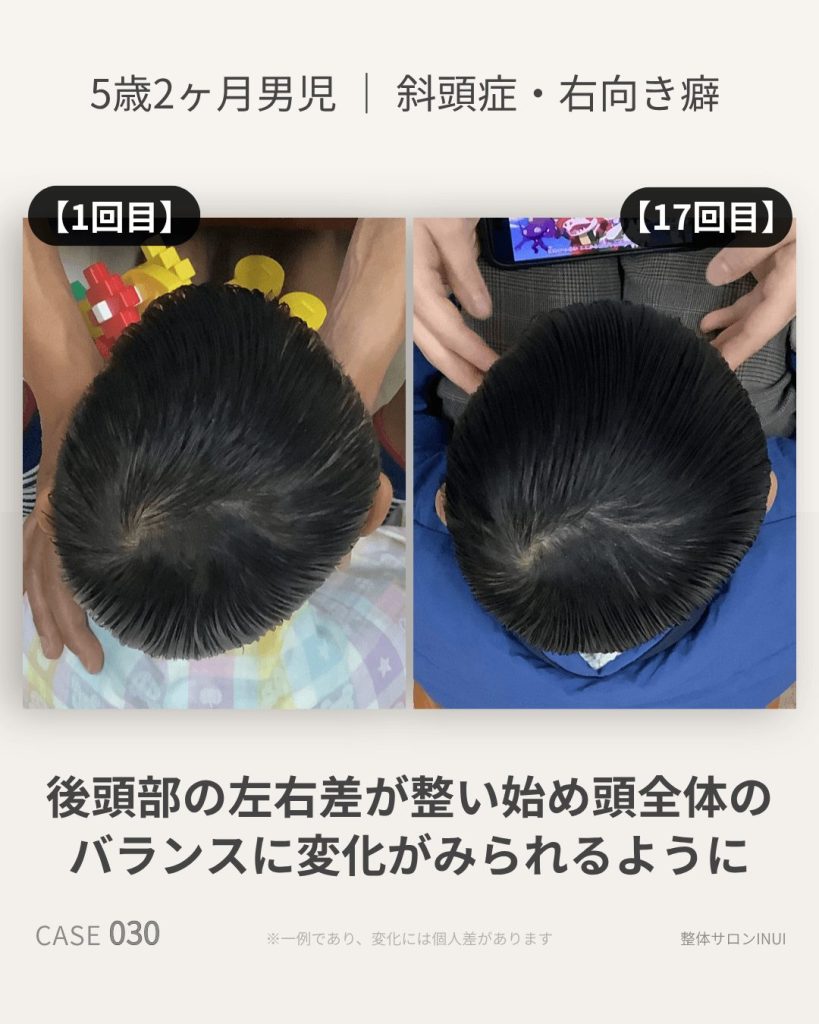 5歳2ヶ月男児の斜頭症ビフォーアフター比較