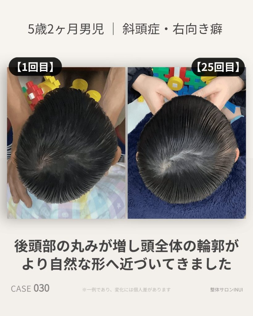 5歳2ヶ月男児の斜頭症ビフォーアフター比較