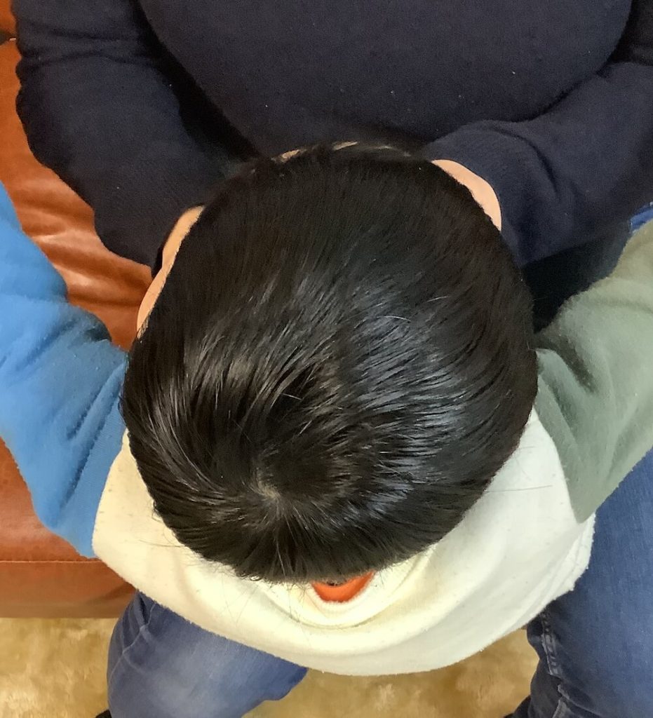 4歳1ヶ月男児の斜頭症による後頭部左右差