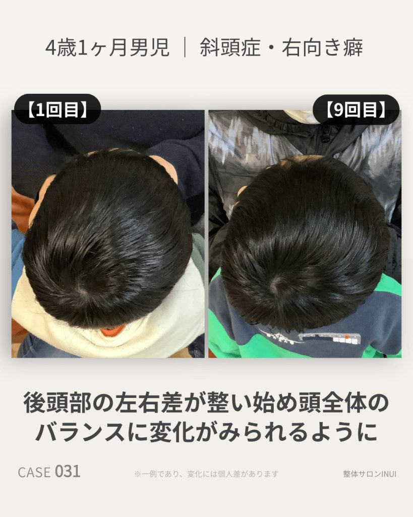 4歳1ヶ月男児の斜頭症ビフォーアフター比較
