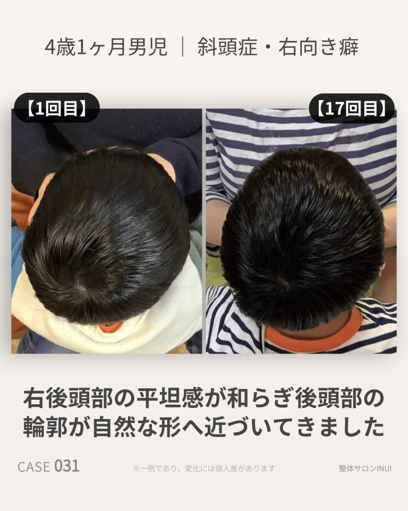 4歳1ヶ月男児の斜頭症ビフォーアフター比較