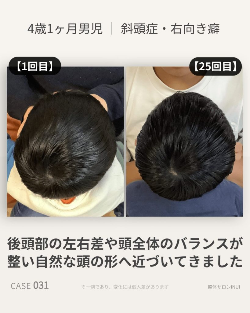 4歳1ヶ月男児の斜頭症ビフォーアフター比較