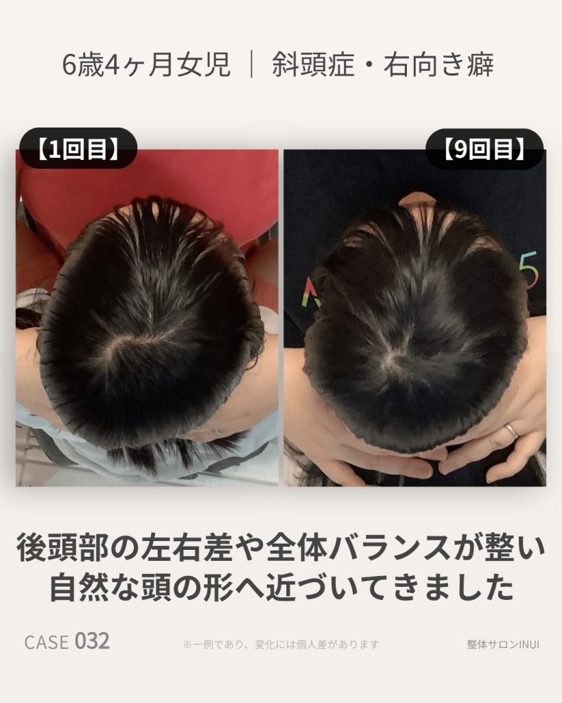 6歳4ヶ月女児の斜頭症による後頭部左右差