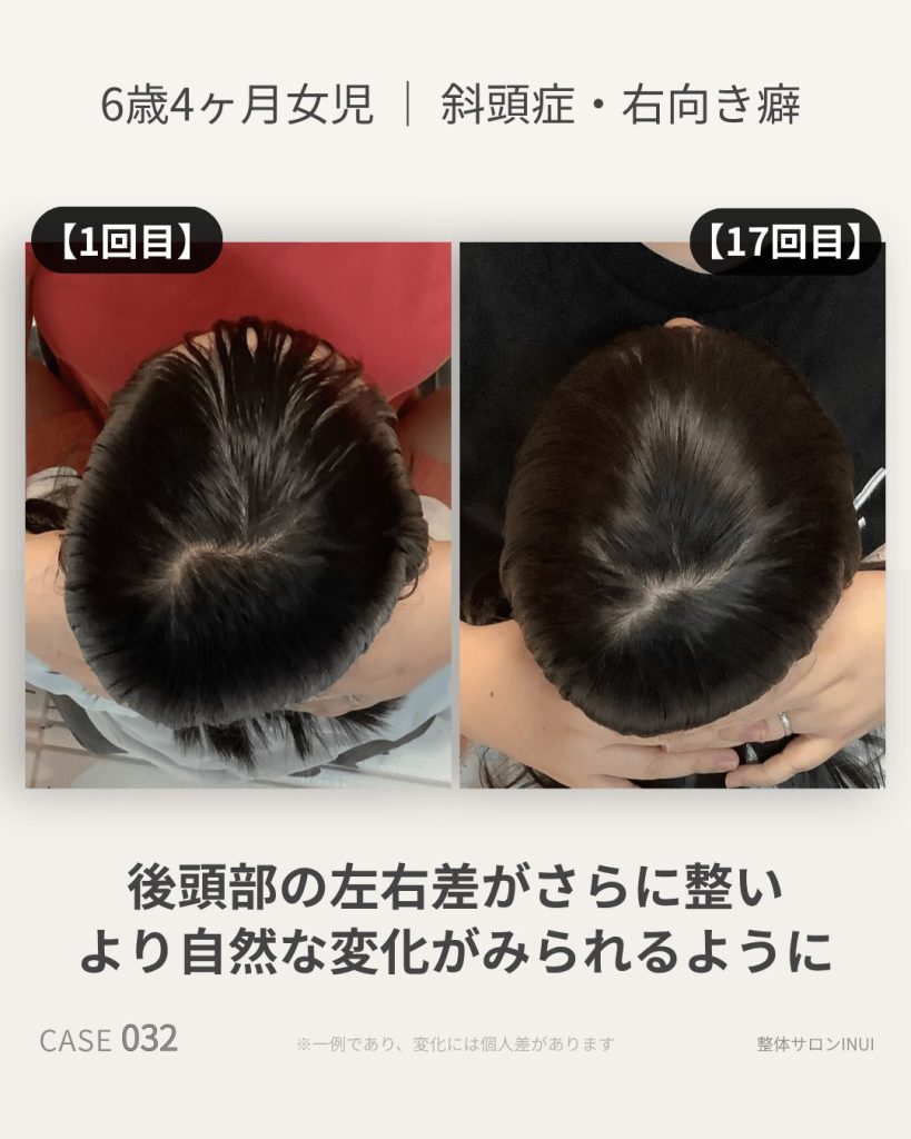 6歳4ヶ月女児の斜頭症による後頭部左右差