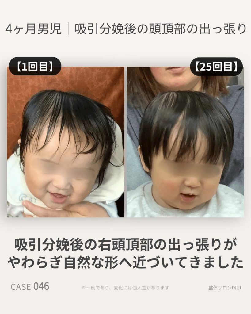 吸引分娩後の右頭頂部の出っ張りのビフォーアフター写真